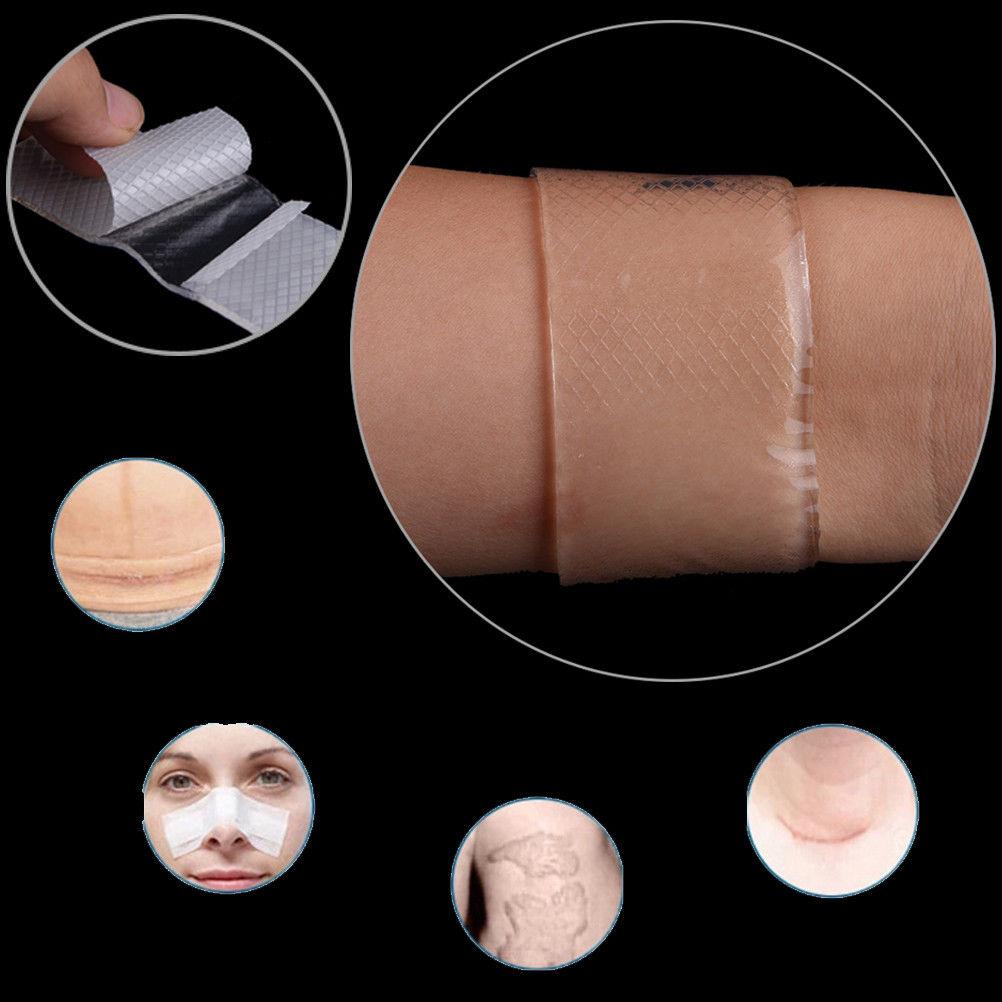 MIRACLE STRETCH MARK + SCAR REMOVAL SHEETS 4