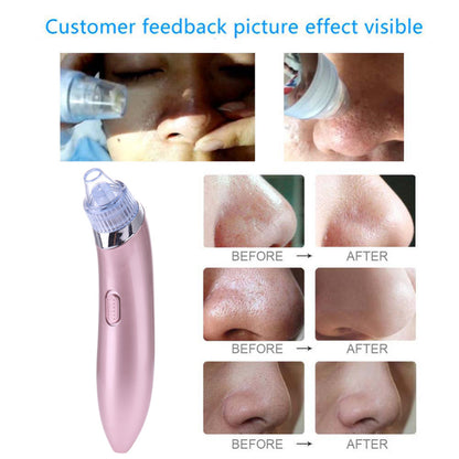 Comedone Vacuum Pro 2
