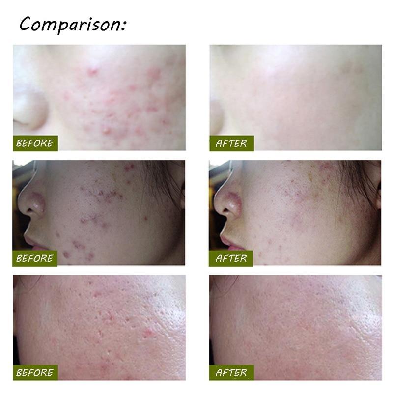 Light Therapy Acne Pen 2