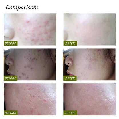Light Therapy Acne Pen 2