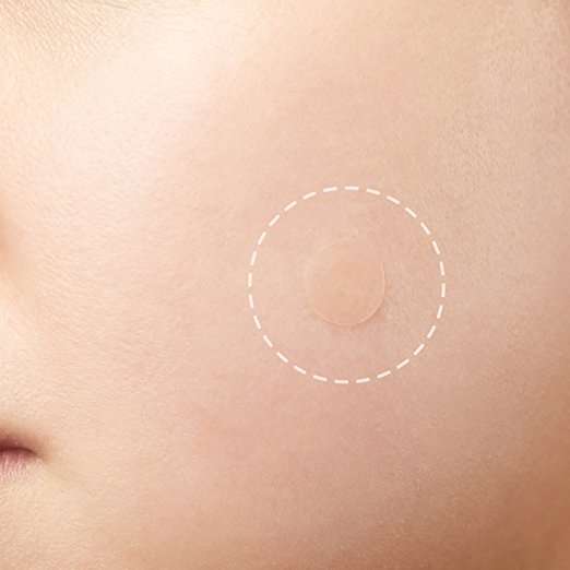 Beauty Acne Patch Set (24 Pcs) 2