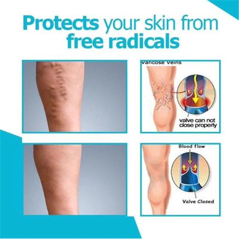 Varicose Veins Miracle Cream 2