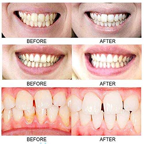 Tooth Whitening Kit 3
