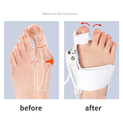 Hallux Valgus Corrector – Toe Separator & Bunion Aligner for Effective Foot Relief and Support 3