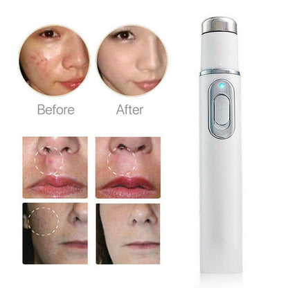 Skin Spots Removal Laze Pen 3