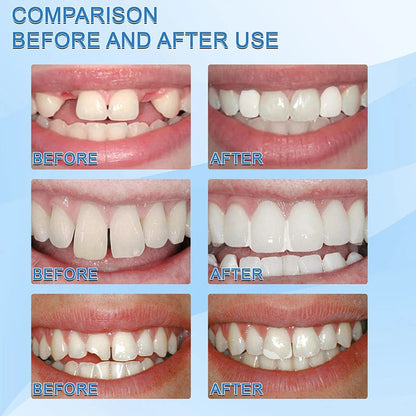 Moldable Broken Teeth Gaps Filling 3