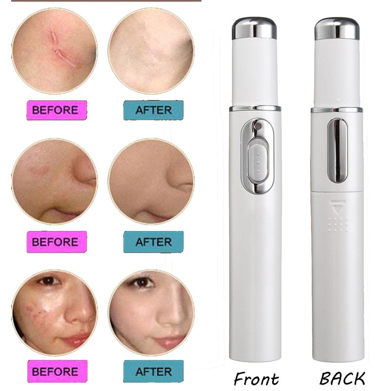 Light Therapy Acne Pen 3
