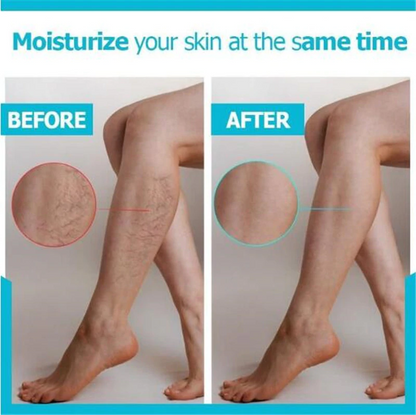 Varicose Veins Miracle Cream 3