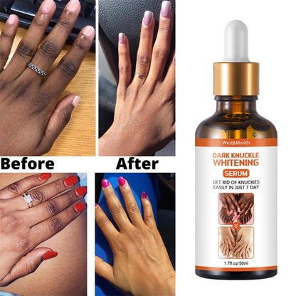 Acanthosis Nigricans Therapy Oil 4
