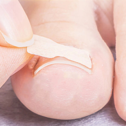 Ingrown Toenail Corrector Patches 4