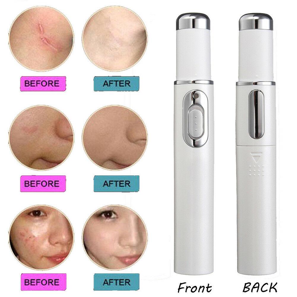 Light Therapy Acne Pen 4