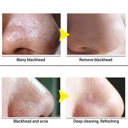 BLACKHEAD STRIP 4