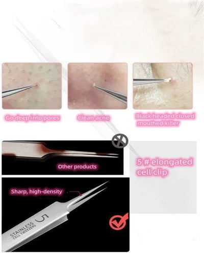 Professional Ultra-fine No.5 Acne Blackhead Removal Tweezers (Pcs 3) 4