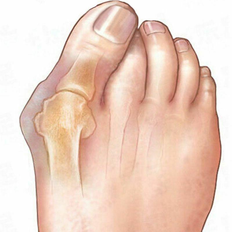 Bunion Corrector 4