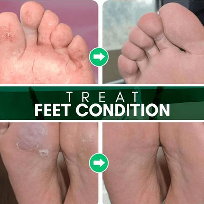 Fungal combat feet spray 5