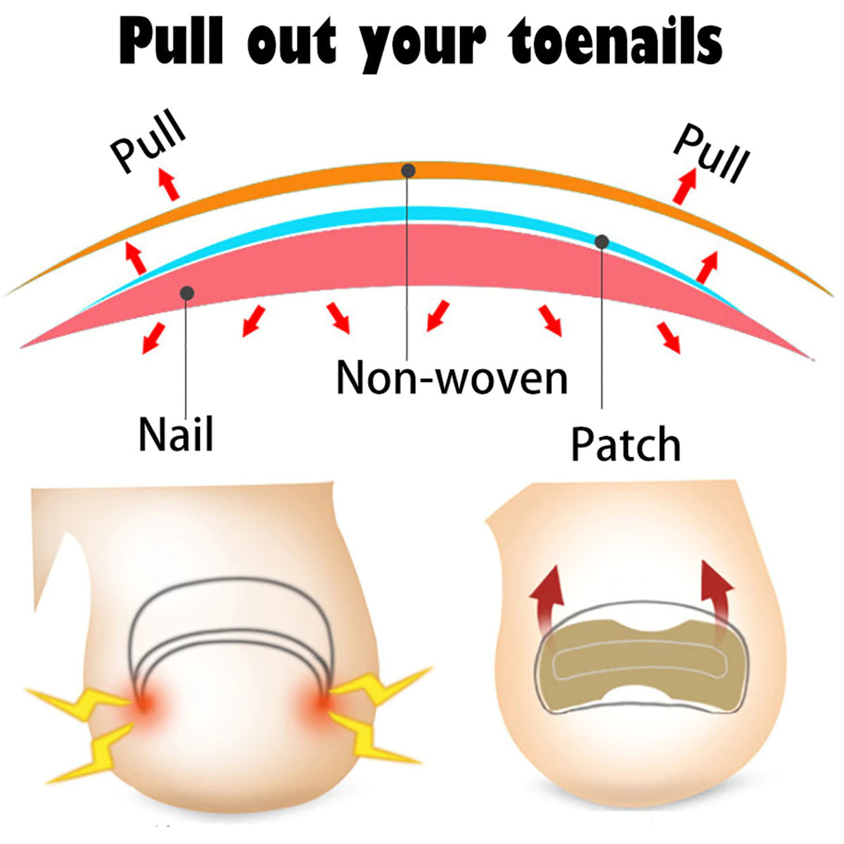 Ingrown Toenail Corrector Patches 5