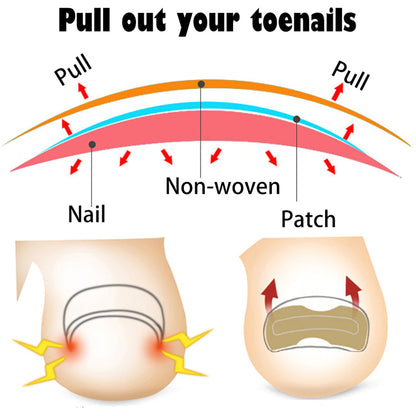 Ingrown Toenail Corrector Patches 5