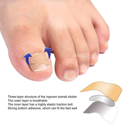 Ingrown Toenail Corrector Patches 6