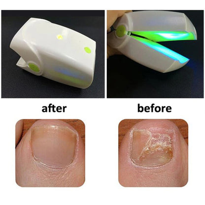 Portable Fungus Nail Laser 6