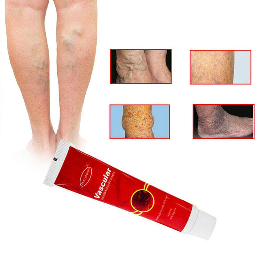 VARICOSE VEINS REMOVAL CREAM 1